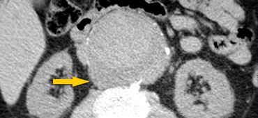 Draped aorta sign. Patient died 3 hours later.