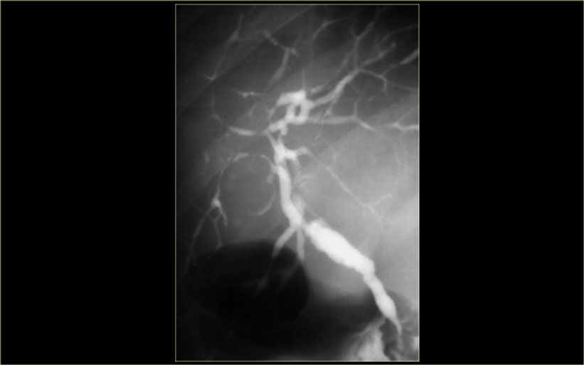 Primary sclerosing cholangitis. Cholangiographic findings