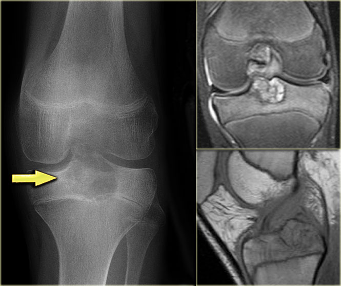 Chondroblastoma