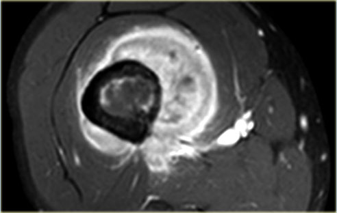 Ewing sarcoma