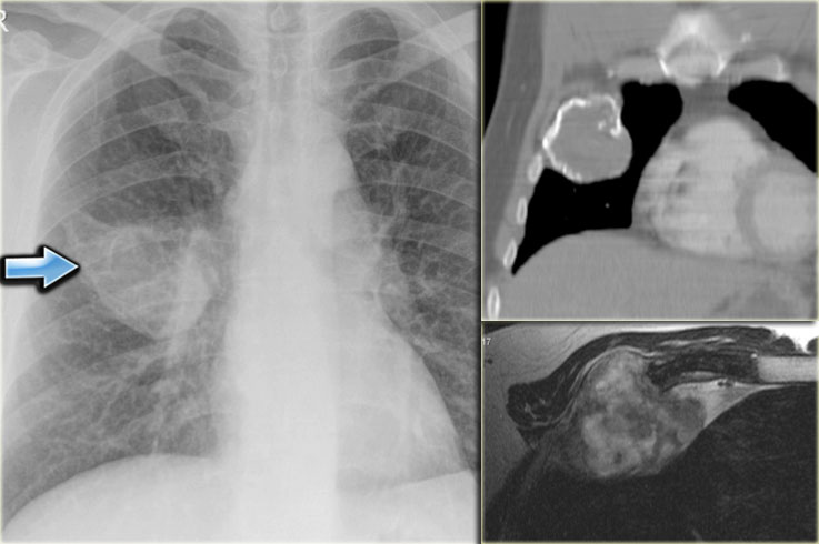 Fibrous dysplasia of a rib