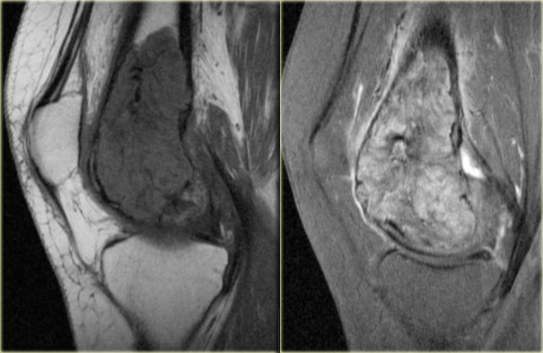 GCT in distal femur