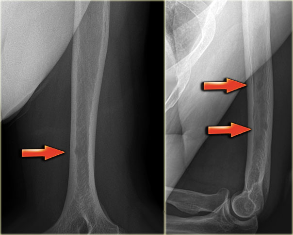 Multiple Myeloma: multiple lytic lesions in the humerus