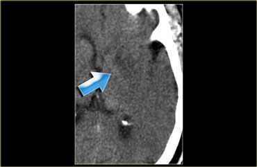 Obscuration of the lentiform nucleus or blurred basal ganglia