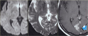 Pseudo-normalization of DWI in a 2 weeks old posterior infarction.