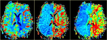 Perfusion images demonstrating large penumbra