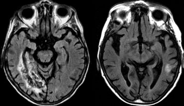 Infarction of right hippocampal region (courtesy Frederik Barkhof)