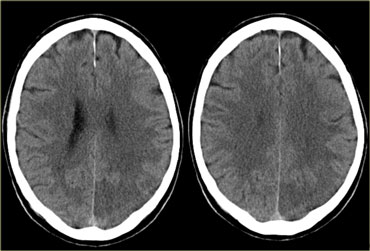 PCA infarction