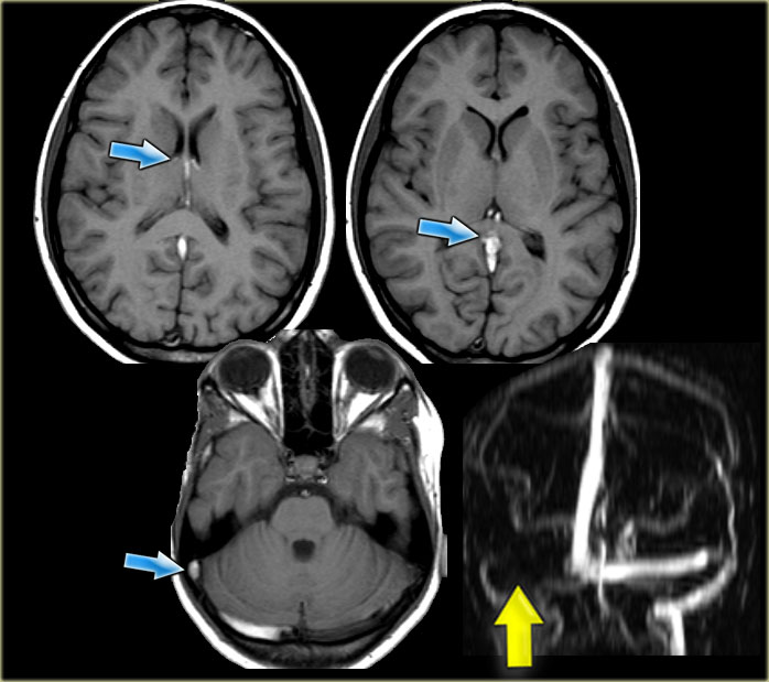 Deep cerebral vein thrombosis