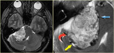 Schwannoma in CPA-region with typical features of an extraaxial tumor (T2WI)