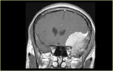 Coronal enhanced T1WI. Meningioma with dural tail, hyperostosis of adjacent bone and homogeneous enhancement