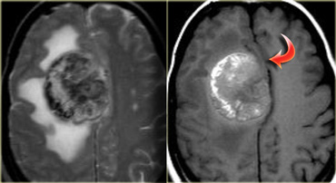 Melanoma metastasis: T2WI and T1WI