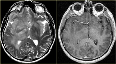 Low grade astrocytoma