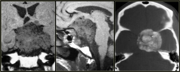 Calcified meningioma