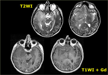 Low grade astrocytoma. No enhancement.