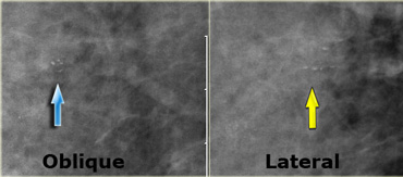 LEFT: cluster of pleiomorphic calcifications on oblique viewRIGHT: milk of calcium (teacups) on lateral view with horizontal beam