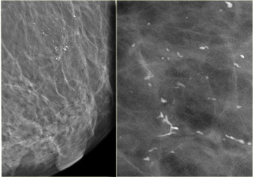 Coarse heterogeneous calcifications in fibrous stroma