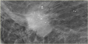 Fine pleomorphic calcifications in a segmental distribution in combination with an irregular mass (Bi-RADS 5)