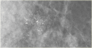 Amorphous and fine pleomorphic calcifications (Bi-RADS 4)Biopsy: fibrocystic changes