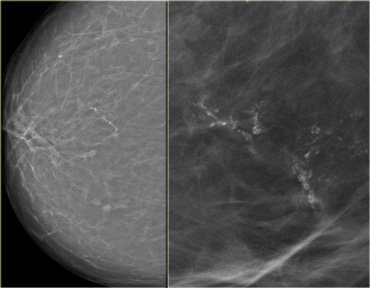 High grade DCIS: Fine pleomorphic and fine linear calcifications in a linear distribution