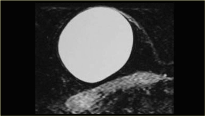 Epidermal inclusion cyst with smooth margins