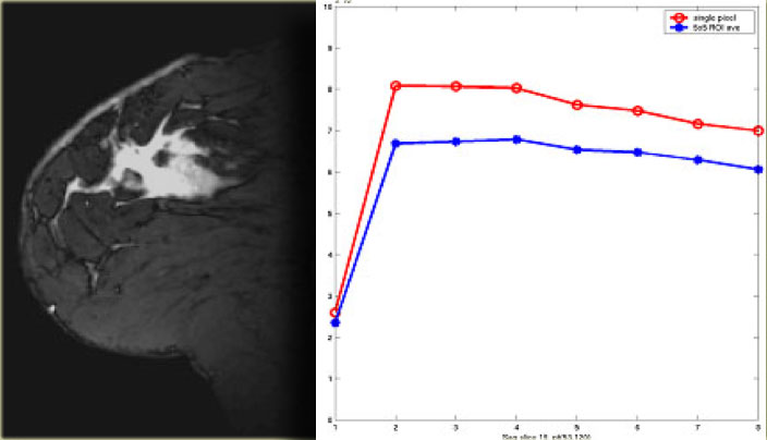 Type 3 curve with rapid initial rise, followed by washout in the delayed phase