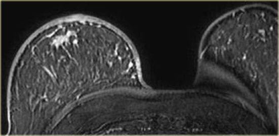 Carcinoma with extensive thickening of the skin