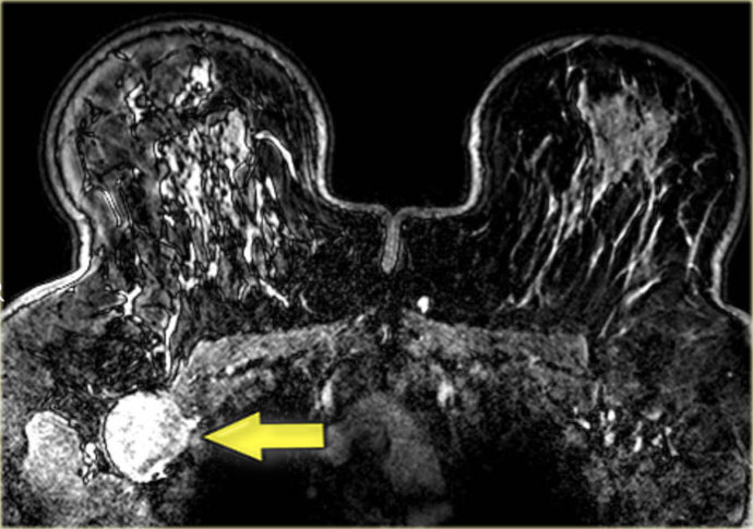 Enhancing large lymph node (arrow) in a patient with breast cancer