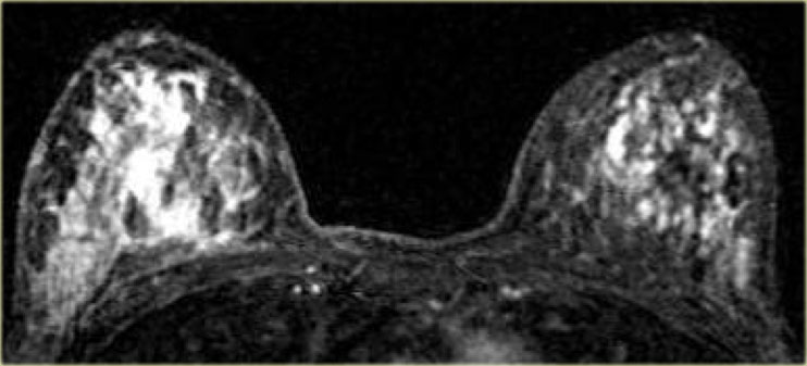 DCIS bilaterally