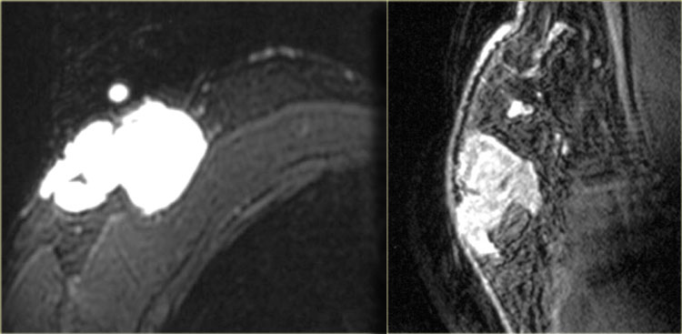 Terminal duct carcinoma