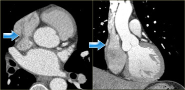 Axial (left) and coronal (right) reconstructions showing the crista terminalis (blue arrows) and its location in the right atrium