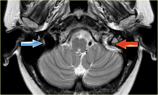 Venous thrombosis with absence of normal flow void on T2-weighted image..