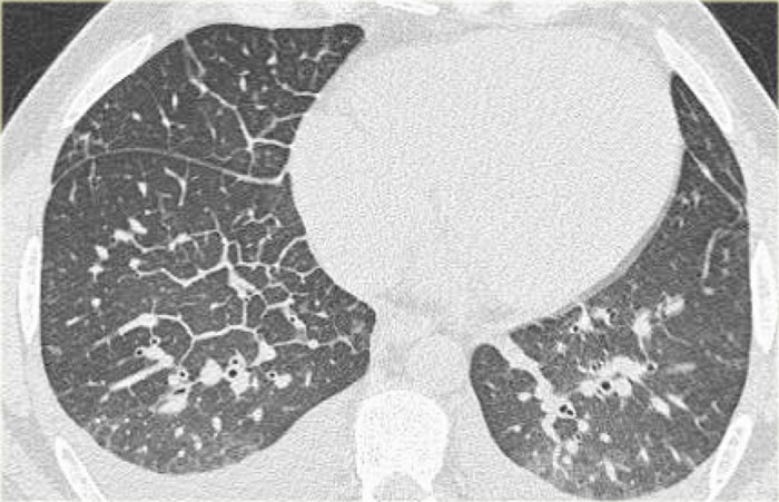 Thickened septal lines due to interstitial edema in CHF