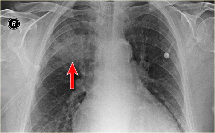 Lobar pneumonia