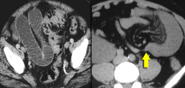 'U' or 'C' shaped loops of bowel. Point of obstruction has a beak-like appearance