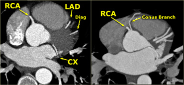 LEFT: RCA comes off the right sinus of ValsalvaRIGHT: Conus artery comes off directly from the aorta