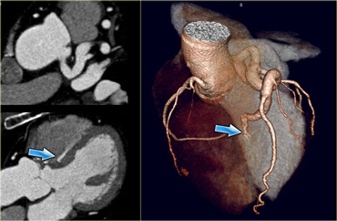 Left to right shunt: septal branch of LAD teminates in right ventricle