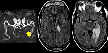 PCA infarction involving the medial temporal lobe.