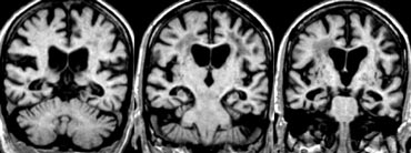 MTA in a patient with VaD