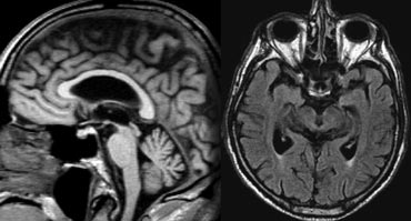 PSP with midbrain atrophy