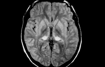 Pulvinar hyperintensity in new variant of CJD. Courtesy Dr. Collie (12)