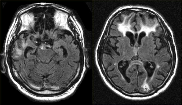 Traumatic brain injury