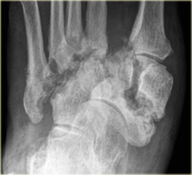 Chronic stage of Charcot osteoarthropathy