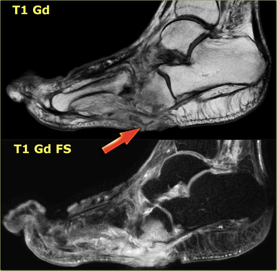 Osteomyelitis in chronic Charcot neuro-osteoarthropathy