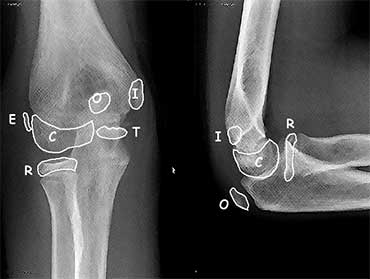 The order of appearance of the ossification centres is specified in the mnemonic C-R-I-T-O-E.