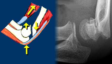 Flexion-type supracondylar fracture caused by direkt impact