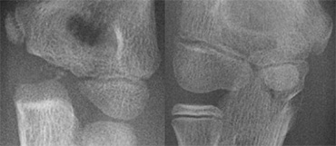 Two cases of overprojection of the capitellum on humeral epiphysis simulating a fracture. Notice olecranon fracture on the right