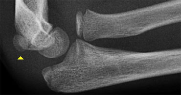 Normal medial epicondyle projecting posteriorly. Notice radial head dislocation and olecranon fracture