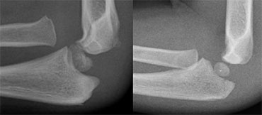 LEFT: an obvious radial dislocation. No fracture of the ulna (Monteggia) was foundRIGHT:  a subtle radial head dislocation. Associated olecranonfracture is seen on carefull inspection