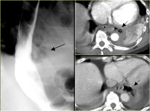 Boerhaave's syndrome